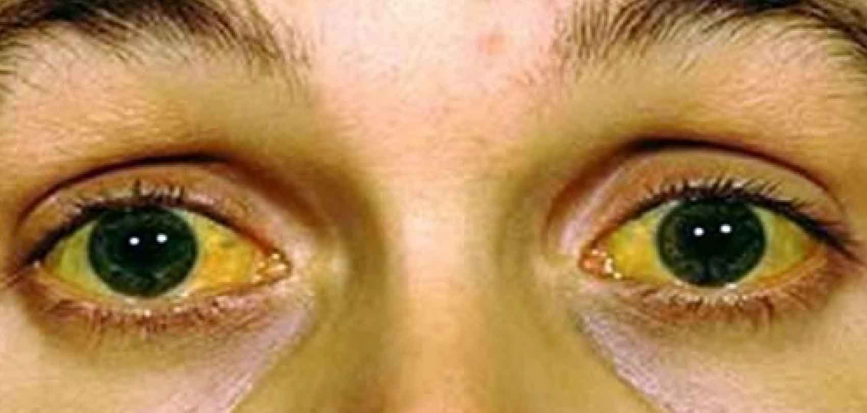 के तपाईलाई जन्डिस छ ? बच्ने  घरेलु उपायहरु यस्ता छन् 
